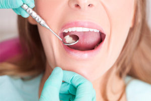 dental filling in chula vista