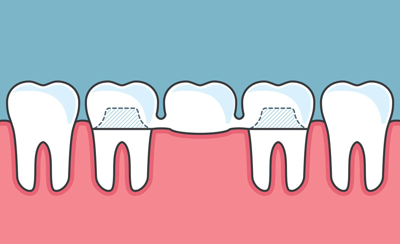 How Do Dental Bridges Work?