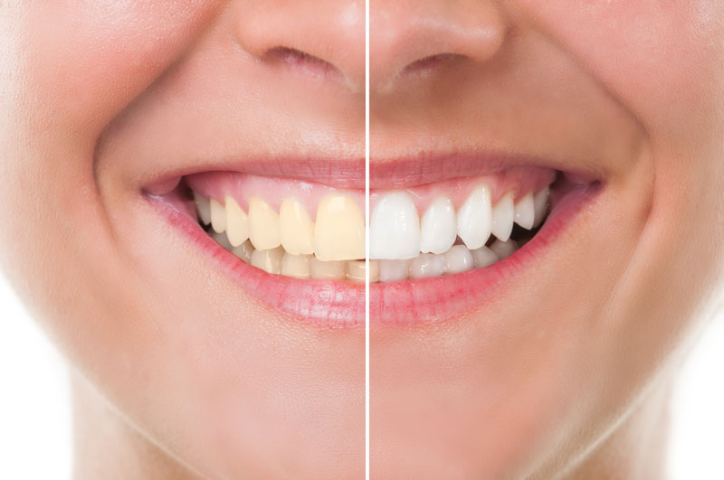 teeth whitening chula vista