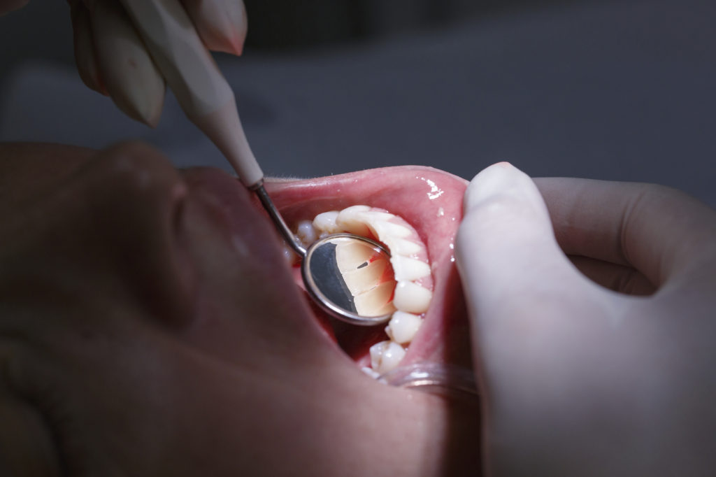 5 Common Signs of a Bad Tooth