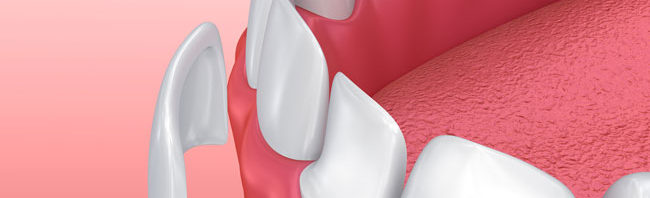 Porcelain Dental Veneers in Eastlake Chula Vista