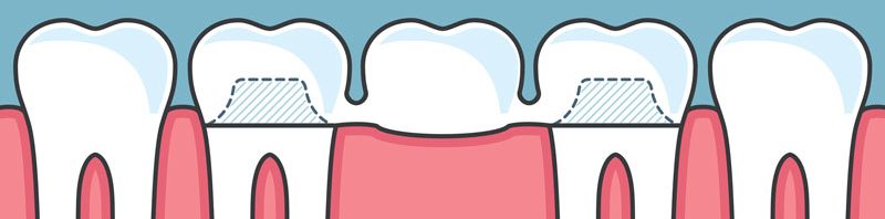 How Do Dental Bridges Work?