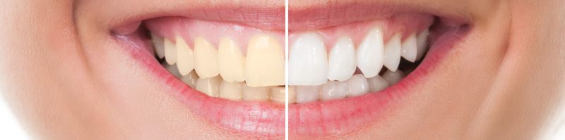 teeth whitening chula vista