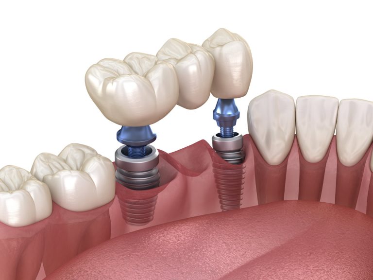 implant-dentist3