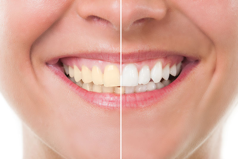 Teeth Whitening in Chula Vista